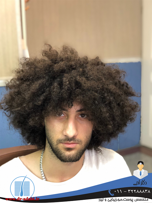 کاشت مو 1