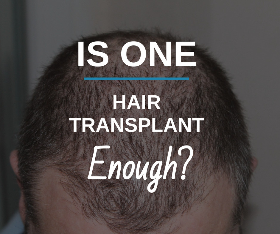 ?is one-Hair Transplant Enough