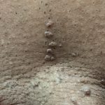 زگیل تناسلی wart