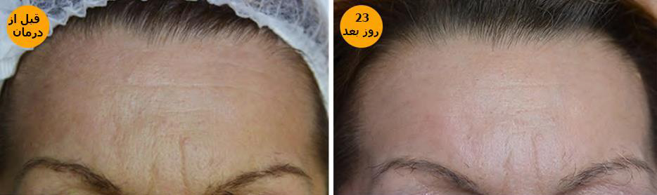 قبل و بعد درمان پوست باتیکسل