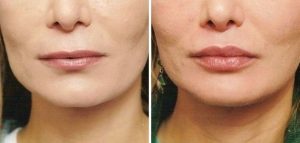 تزریق چربی به لب lip fat injecton