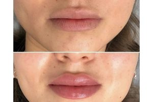 lip fat injetion تزری چربی به لب