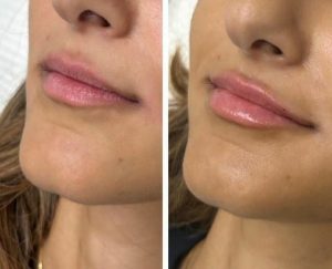 تزریق چربی به لب lip fat injection