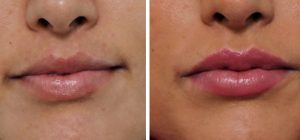 lip fat injection تزریق چربی به لب