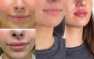 تزریق ژل به لب lip filler injection