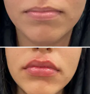 lip filler injection 