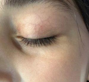 کاشت مژه : دکتر مرتضی ادبی
eyelash transplant 