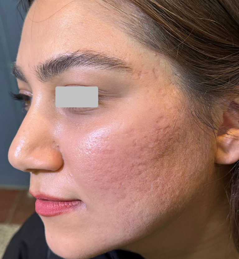 درمان جای جوش Acne Scar