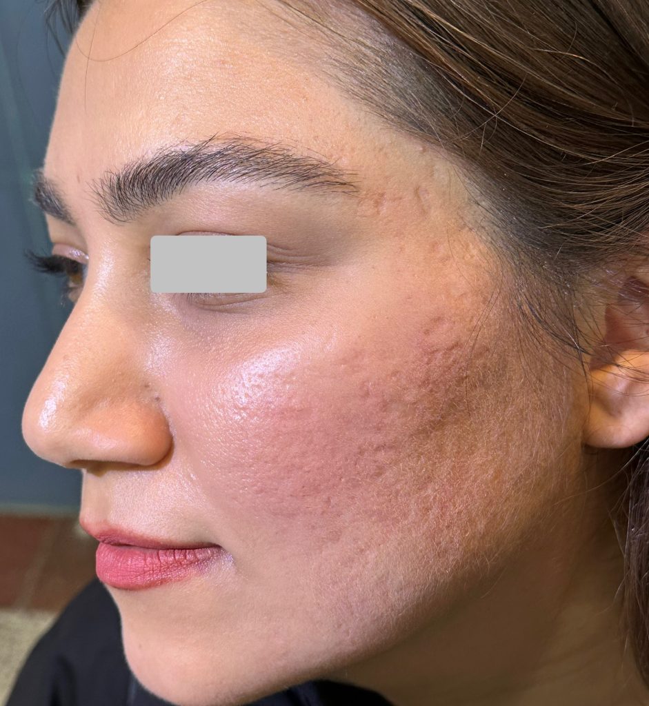درمان جای جوش Acne Scar