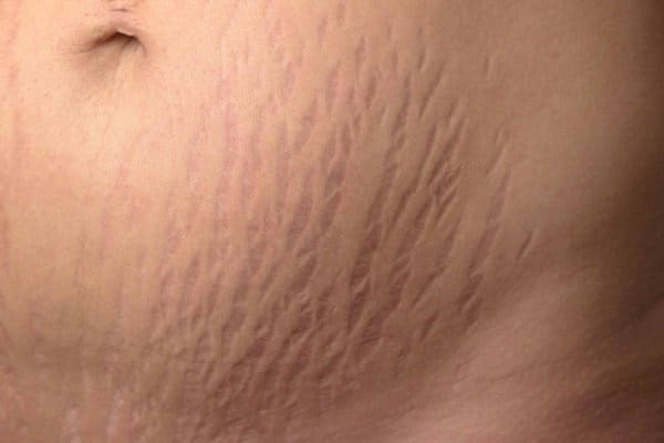 «ترک پوستی یا استریا روی پوست شکم؛ خطوط قرمز و سفید ناشی از کشش سریع پوست